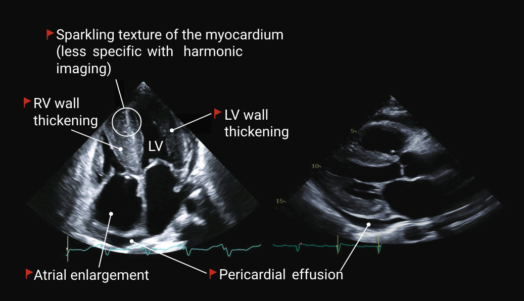 AI Detection of Cardiac Amyloidosis: A Breakthrough in Heart Disease Diagnosis
